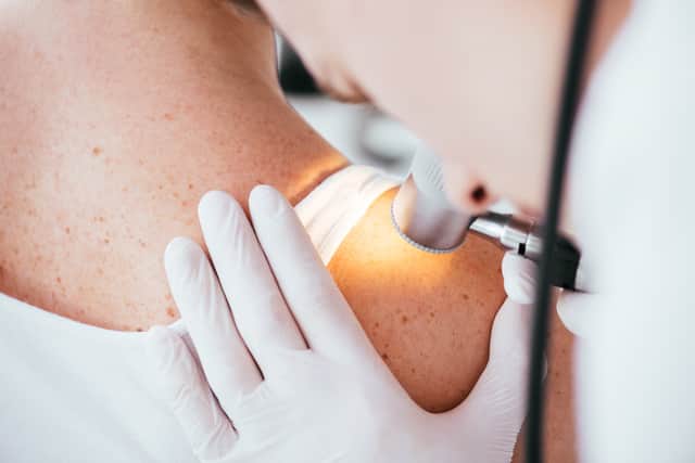 Skin cancer diagnosis rates are up across the UK. Image: LIGHTFIELD STUDIOS - stock.adobe
