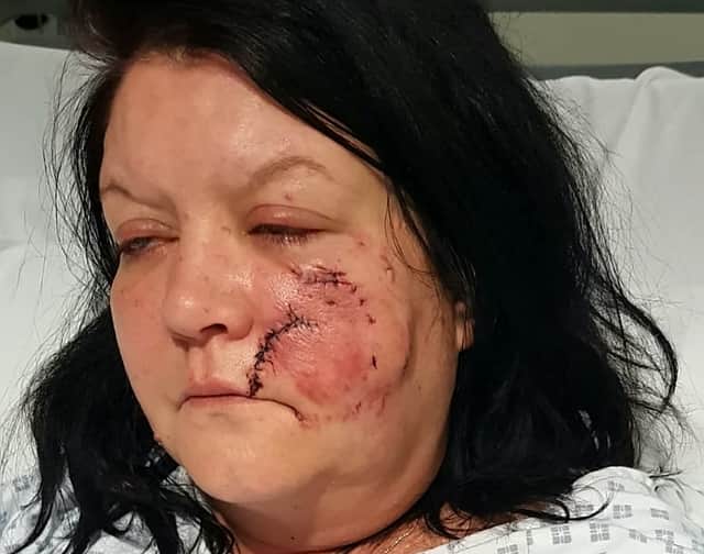 Rachel says she still “cries” whenever she hears a dog growl. Pictured are facial injuries she sustained in the attack.