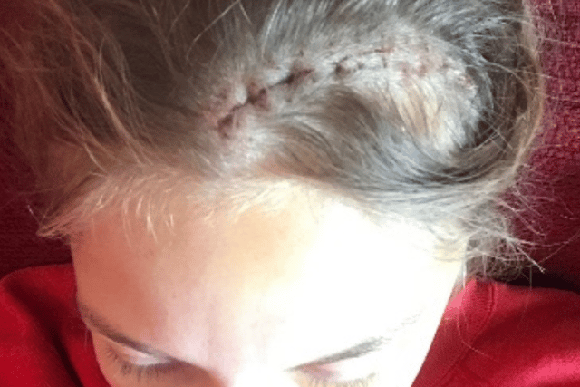 Emma's brain surgery scar.