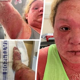 Woman's extreme allergic reaction to mosquito bite on holiday in the Caribbean 