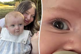 A mum who thought her baby's "wonky" right eye was "adjusting" found out it was a sign of a rare cancer.