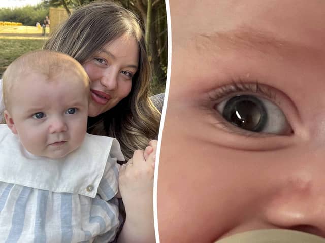 A mum who thought her baby's "wonky" right eye was "adjusting" found out it was a sign of a rare cancer.