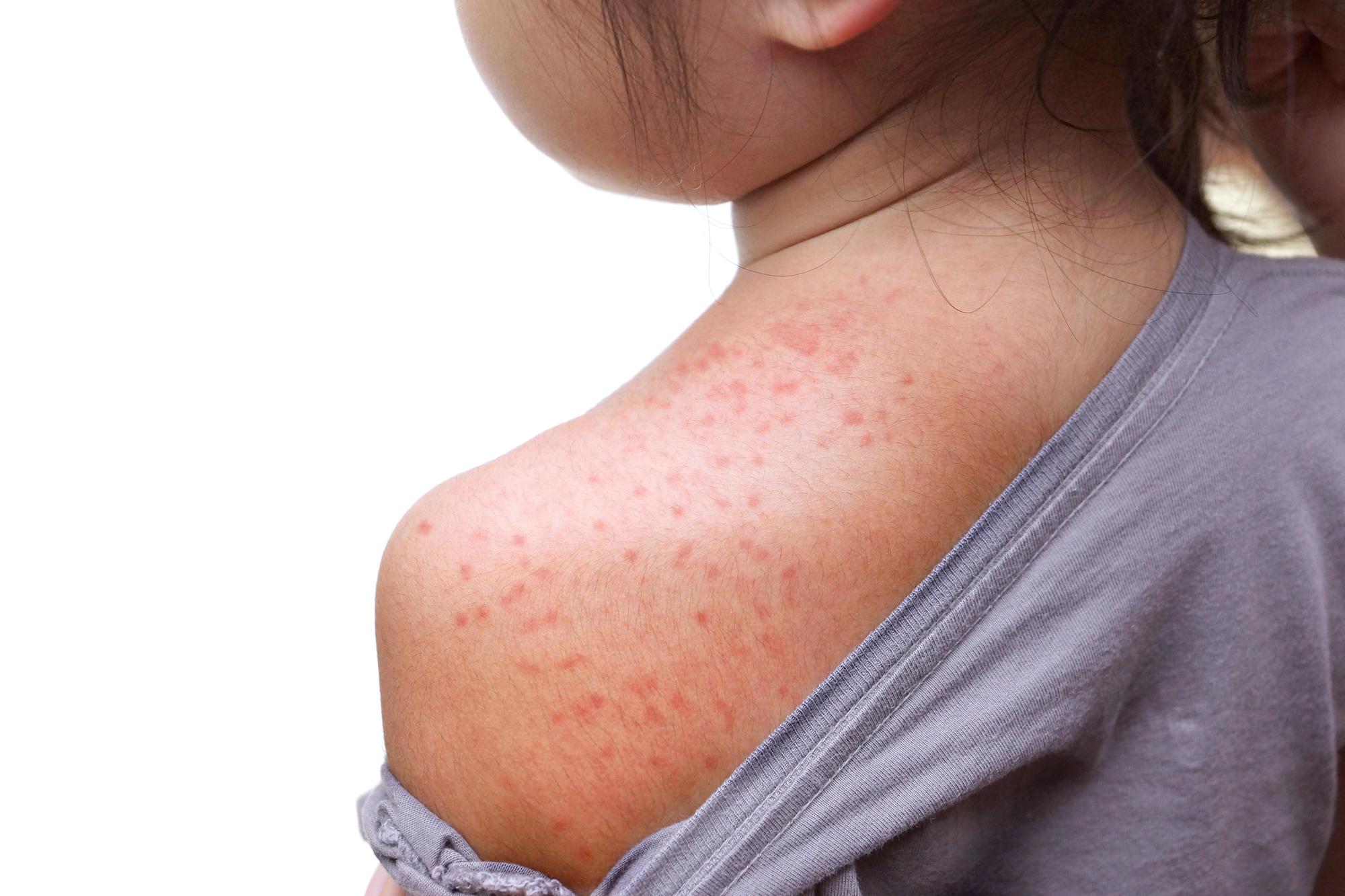 Heat Rash Kids Rfch 'Very young child' unwell with measles as first Wirral case confirmed